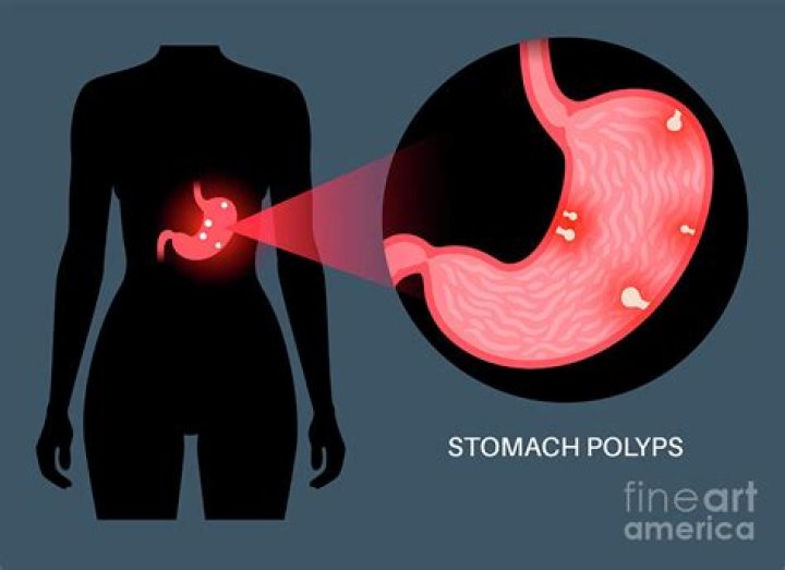 Are stomach polyps serious?