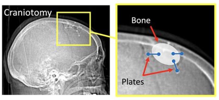 Can craniotomy screws come out?