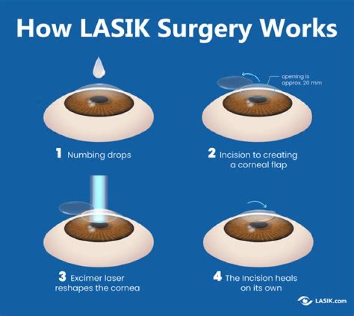 Can I go back to work 2 days after LASIK?