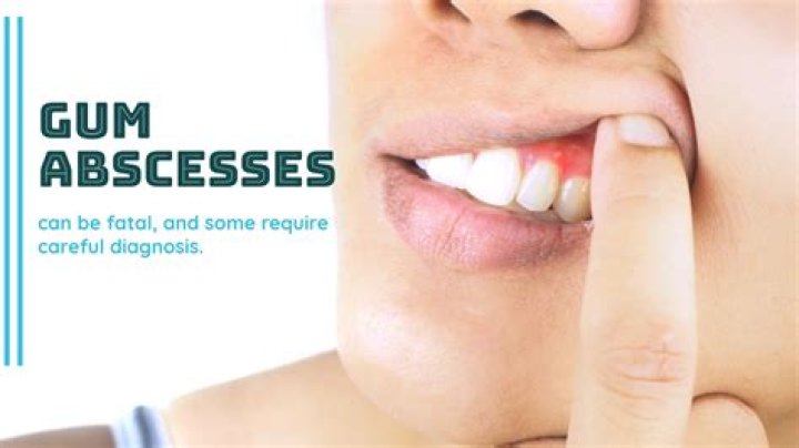 Can I pop a gum abscess?