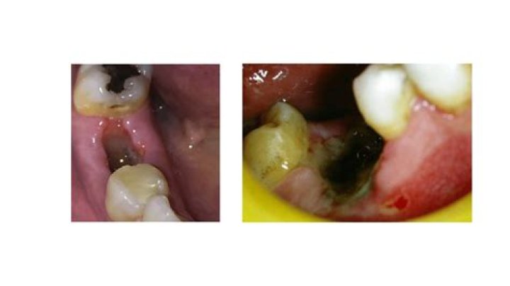 Can I take metronidazole after tooth extraction?
