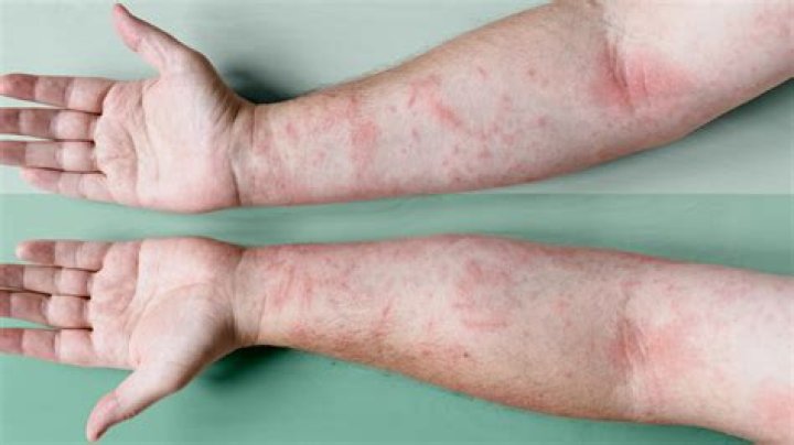 Can ibuprofen help with eczema?