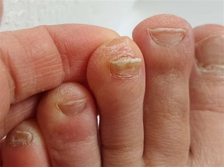 Can toenail fungus cause rheumatoid arthritis?