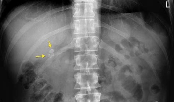Do gallstones show up on xray?