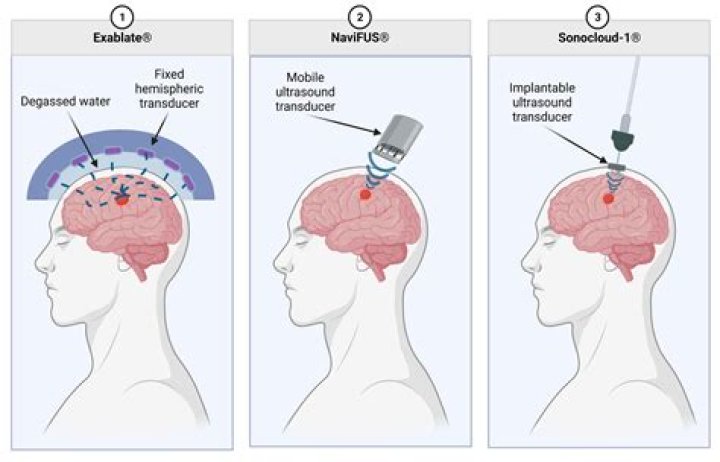 Does anger destroy brain cells?
