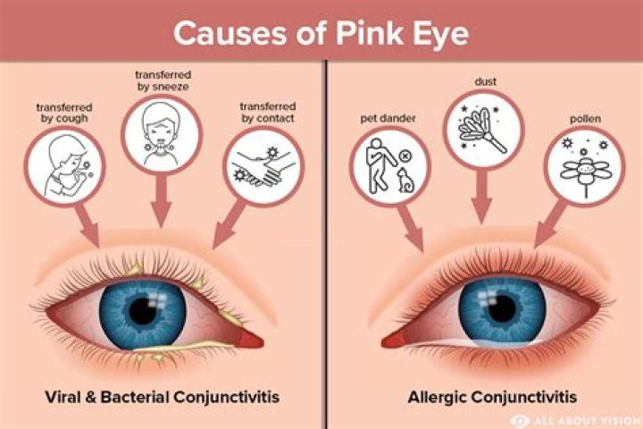 How do u get pink eye?