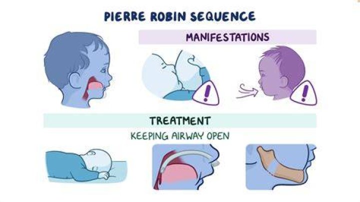 How do you fix Pierre Robin syndrome?