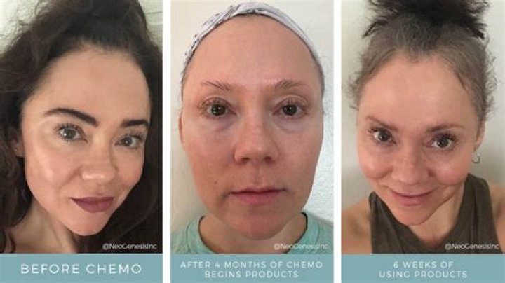 How long after chemo do eyebrows fall out?