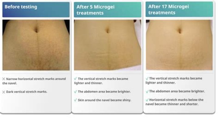 How long does it take for stretch marks to fade naturally?
