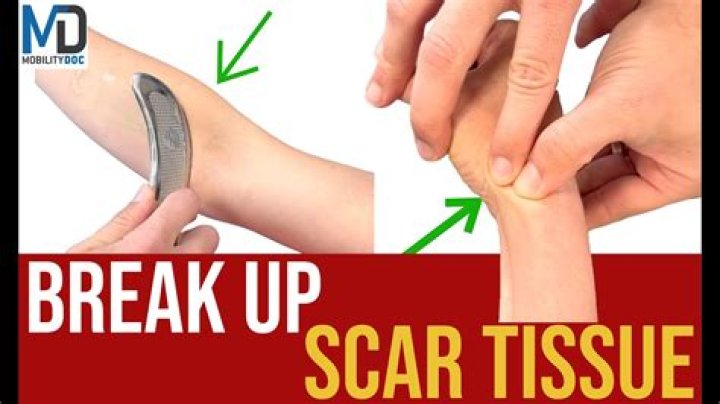 How long does it take to break up scar tissue?