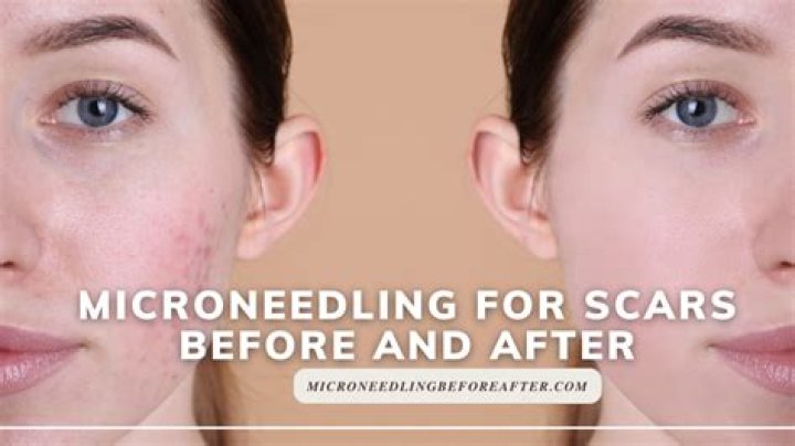 How many sessions of microneedling do you need?