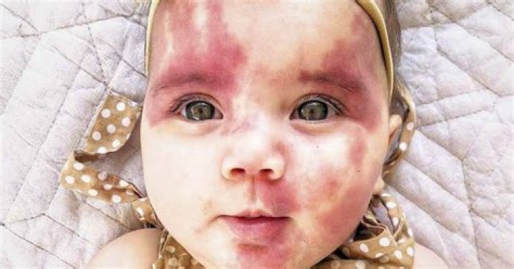 How rare is a red birthmark?