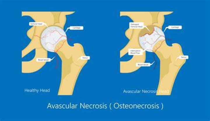 Is avascular necrosis reversible?