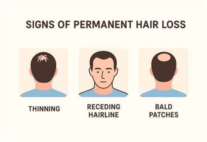 Is chemical hair loss permanent?