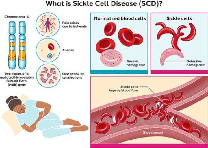 Is Sickle cell Anemia a chromosomal disorder?