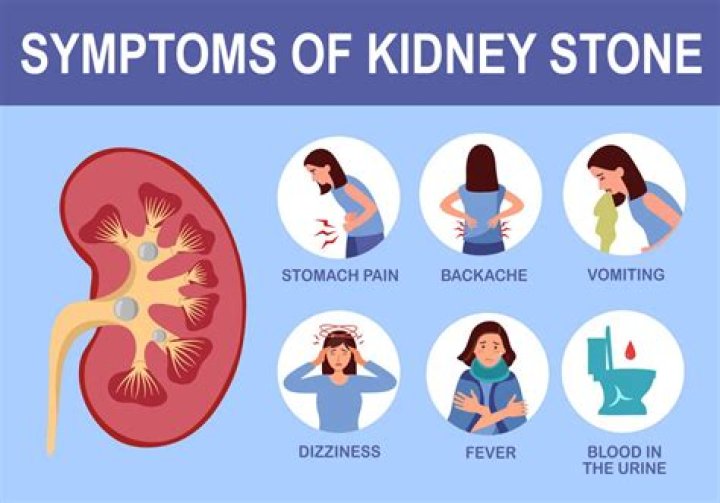 Is Sprite good for kidney stones?