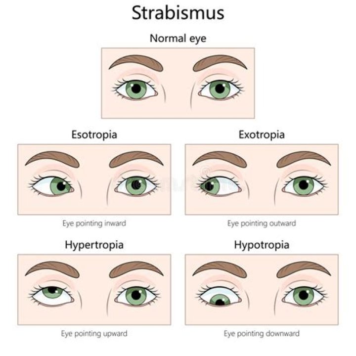Is strabismus covered by insurance?