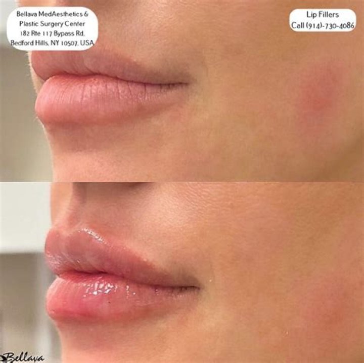 Should lips be hard after filler?