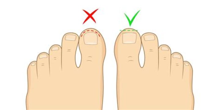 Should you cut your toenails wet or dry?