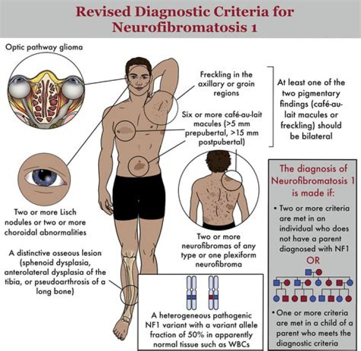 What can be mistaken for neurofibromatosis?
