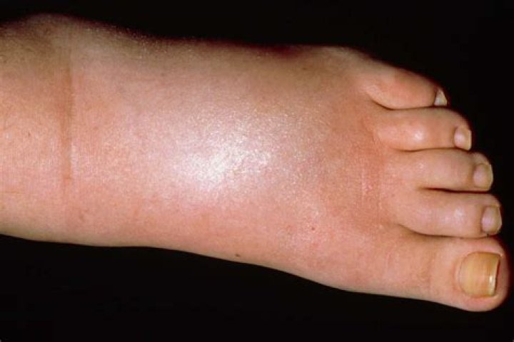 What causes shiny skin on feet?