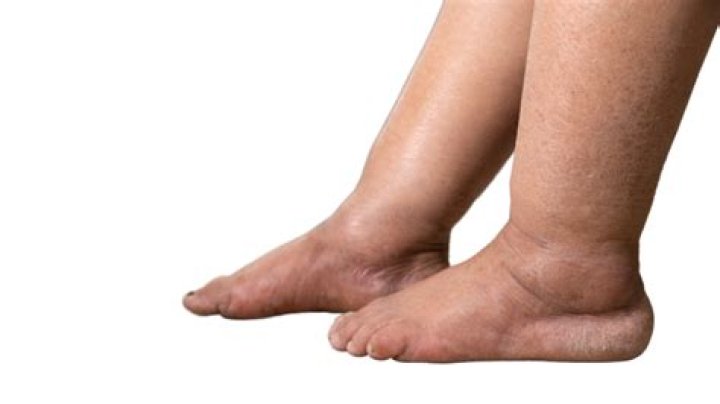 What causes swollen legs from the knee down in elderly?