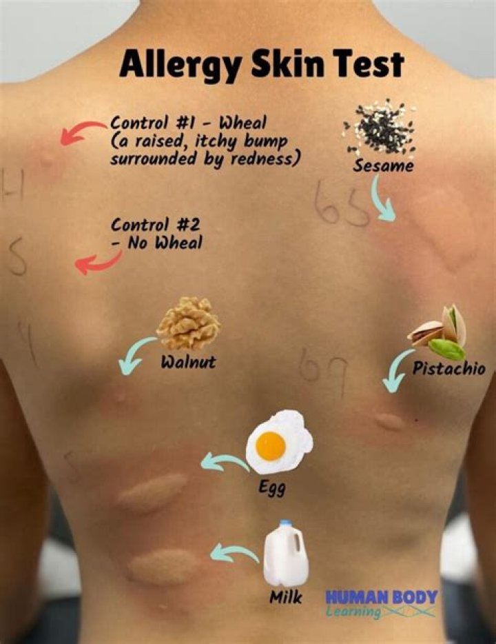 What does a food allergy skin rash look like?