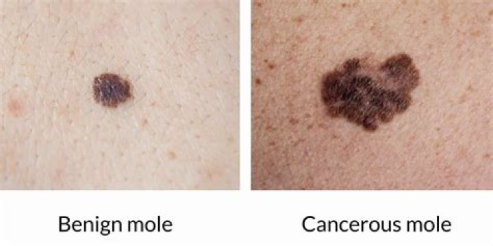 What does an infected mole look like?
