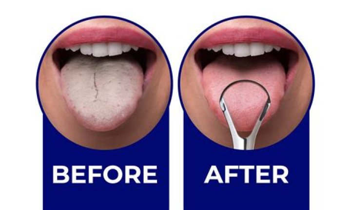What happens if you cut tongue?