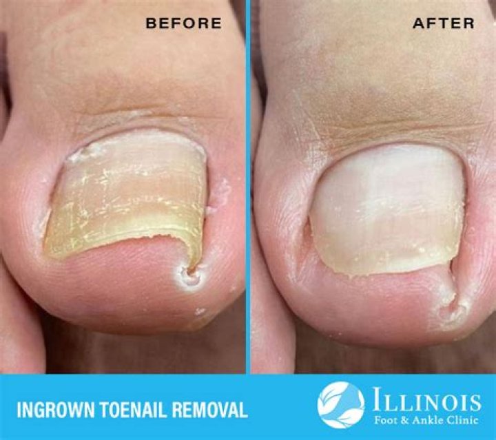 Where do I go for an ingrown toenail?