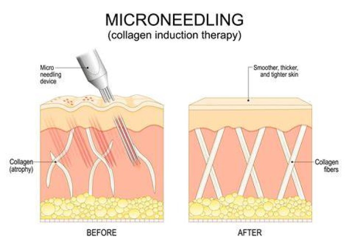 Which is better plasma pen or microneedling?