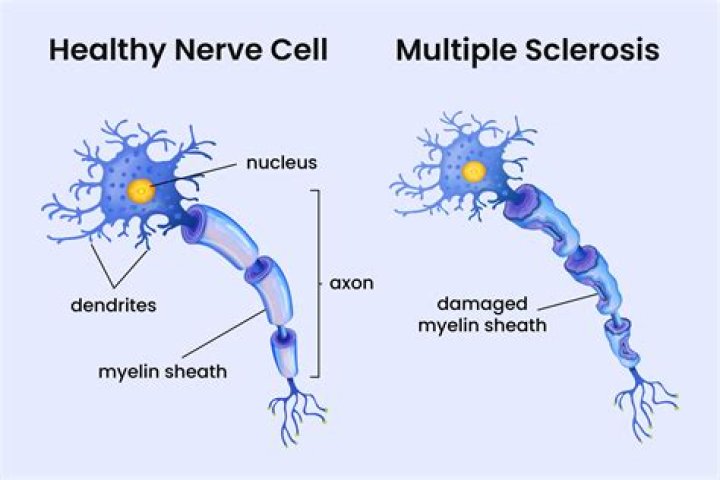 Which NASCAR driver has multiple sclerosis?
