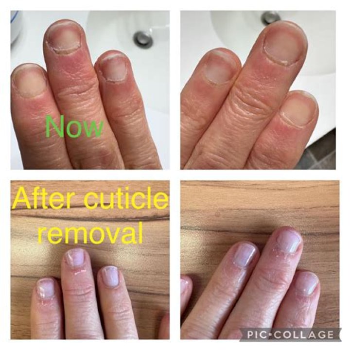 Why are my cuticles swollen after getting acrylics?