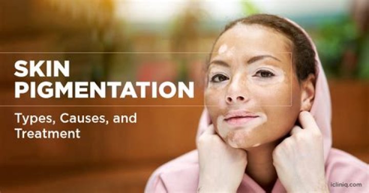 Why is my pigmentation spreading?